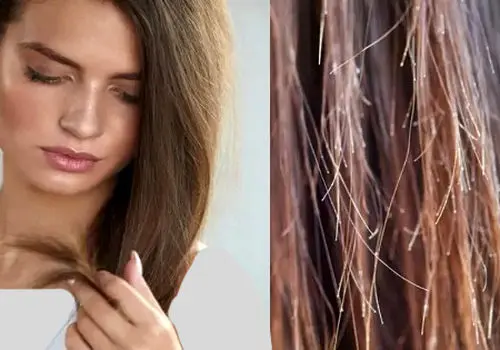 چگونه از موخوره جلوگیری کنیم؟