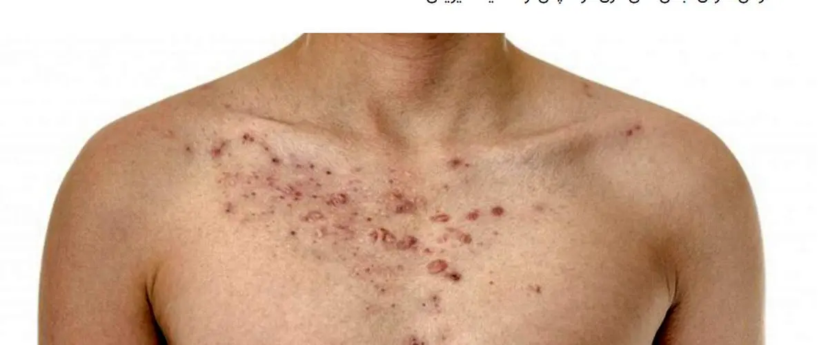 علت جوش سینه و راههای درمان آن
