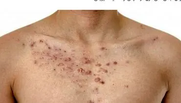علت جوش سینه و راههای درمان آن
