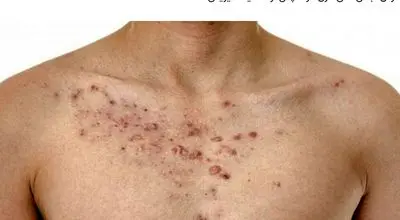 علت جوش سینه و راههای درمان آن
