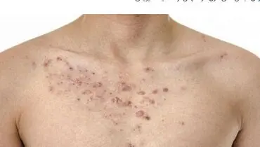 علت جوش سینه و راههای درمان آن
