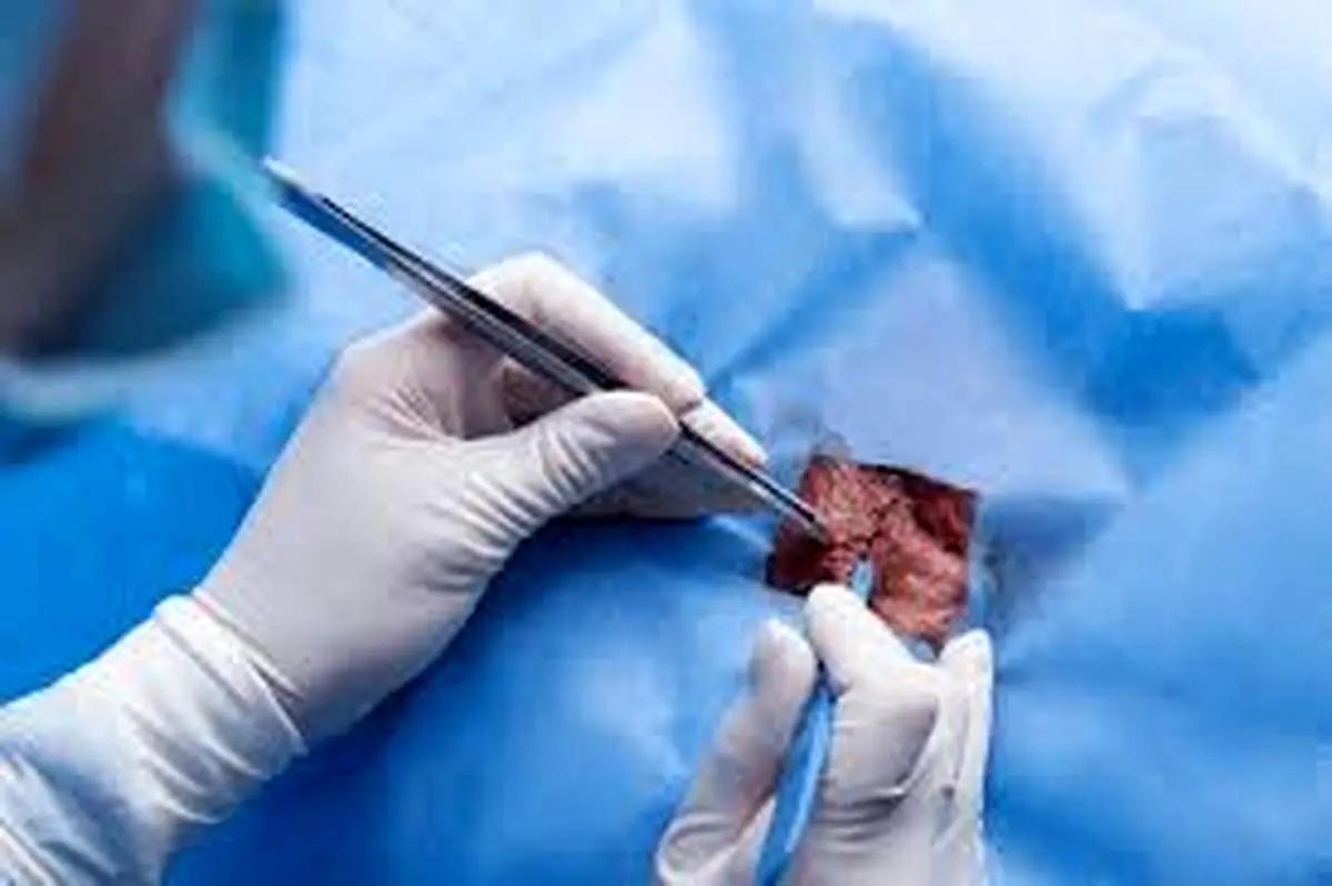 مراقبت های بعد از عمل جراحی فتق به روش باز
