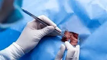 مراقبت های بعد از عمل جراحی فتق به روش باز
