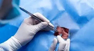 مراقبت های بعد از عمل جراحی فتق به روش باز
