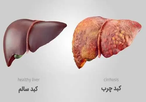 آیا کبد چرب باعث سرطان میشود؟