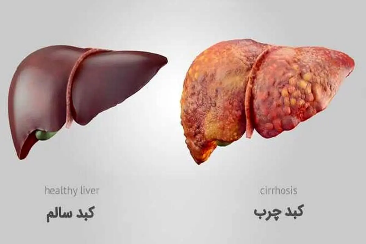 چگونه کبد چرب را درمان کنیم؟