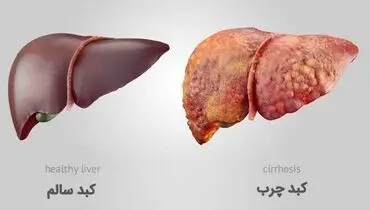 چگونه کبد چرب را درمان کنیم؟