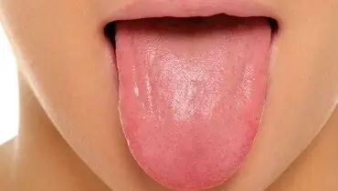 تغییر رنگ زبان یعنی به این بیماری مبتلا شده اید
