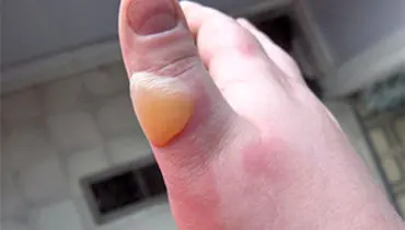 چطور بدون تاول و درد از دویدن لذت ببریم؟
