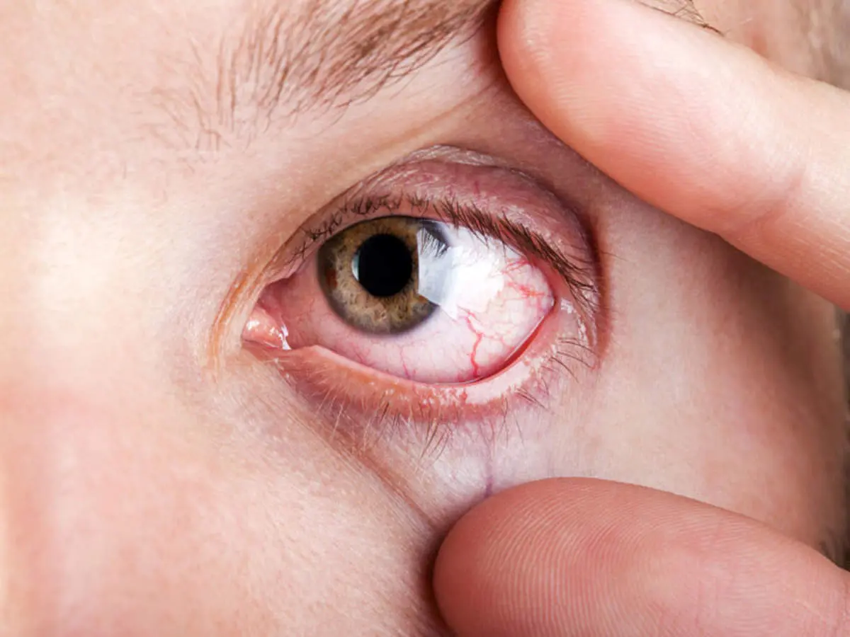 روش های کنترل خشکی چشم در زمستان
