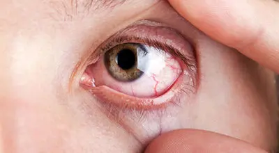 روش های کنترل خشکی چشم در زمستان
