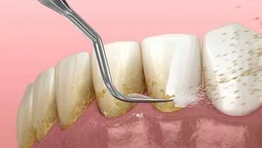 جرم گیری باعث ایجاد فاصله بین دندانی می‌شود؟

