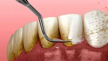جرم گیری باعث ایجاد فاصله بین دندانی می‌شود؟
