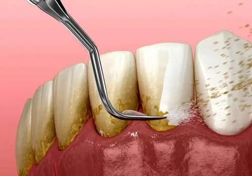 جرم گیری باعث ایجاد فاصله بین دندانی می‌شود؟

