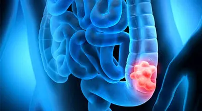 چطور جلوی سرطان روده را بگیریم؟
