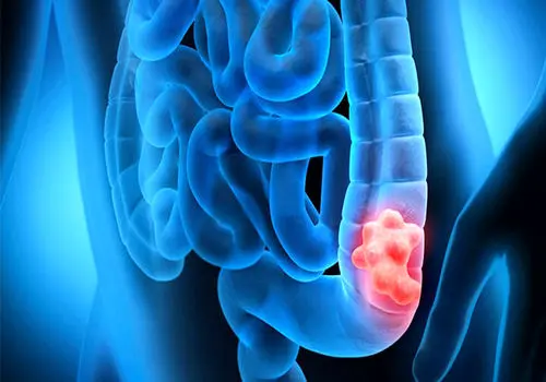 چطور جلوی سرطان روده را بگیریم؟
