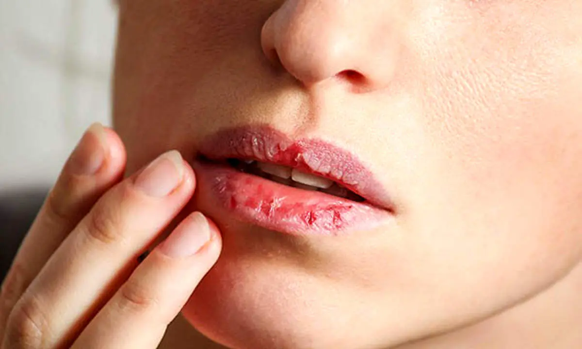 بهترین راه درمان خشکی لب چیست؟