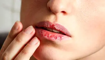 بهترین راه درمان خشکی لب چیست؟