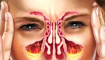 درمان ساده برای عفونت سینوسی