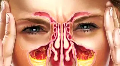 درمان ساده برای عفونت سینوسی