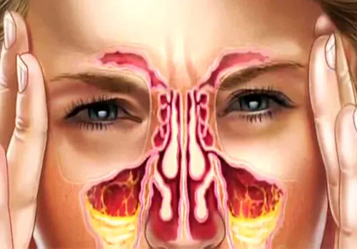 درمان ساده برای عفونت سینوسی