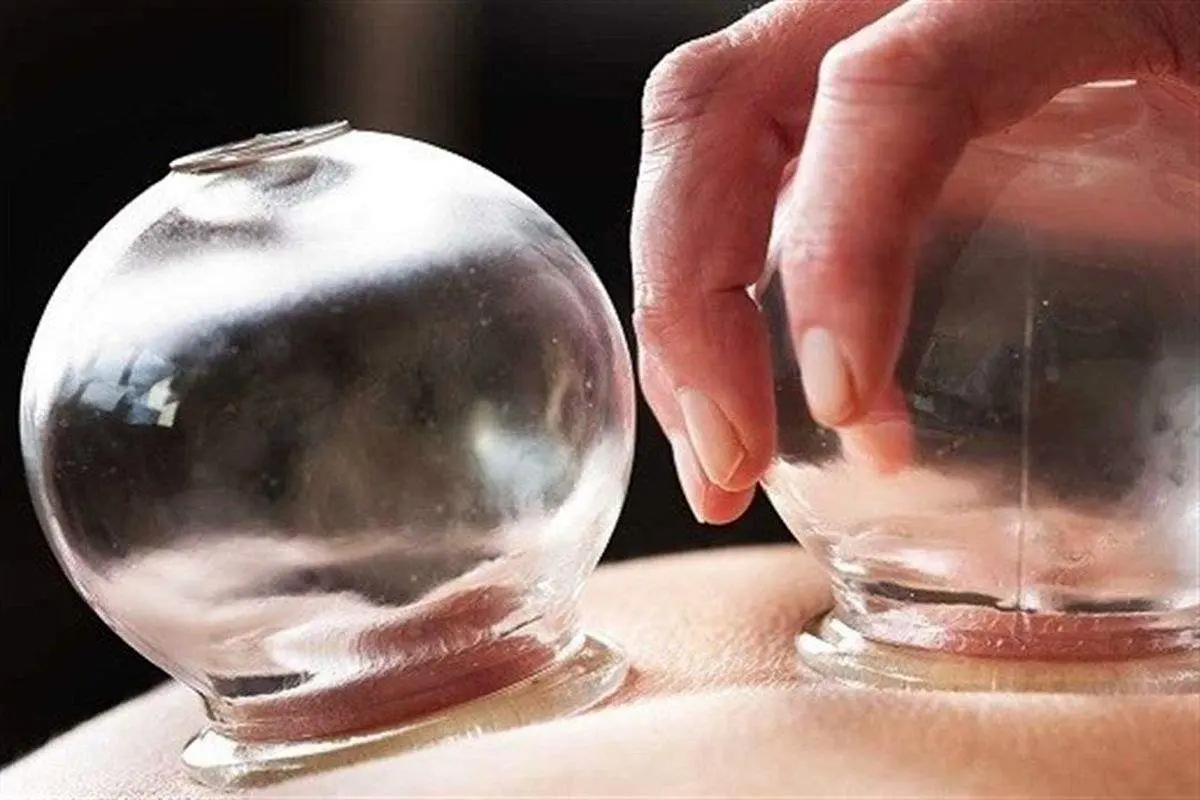 هر آنچه که در مورد حجامت باید بدانید/حجامت چیست و چه عوارضی دارد؟