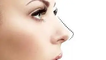 پیزوسرجری بینی چیست و چگونه انجام می شود ؟
