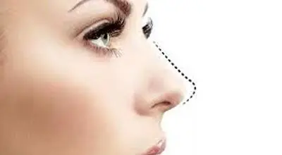 پیزوسرجری بینی چیست و چگونه انجام می شود ؟
