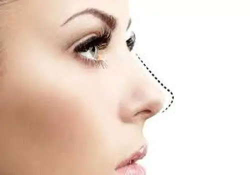 پیزوسرجری بینی چیست و چگونه انجام می شود ؟
