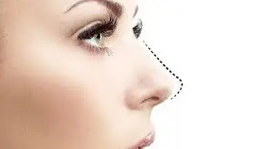 پیزوسرجری بینی چیست و چگونه انجام می شود ؟
