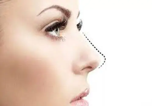 آیا جراحی بینی گوشتی برگشت پذیر است؟
