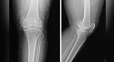 کشف صدها رشته طلای خالص در زانوی زن مبتلا به آرتروز