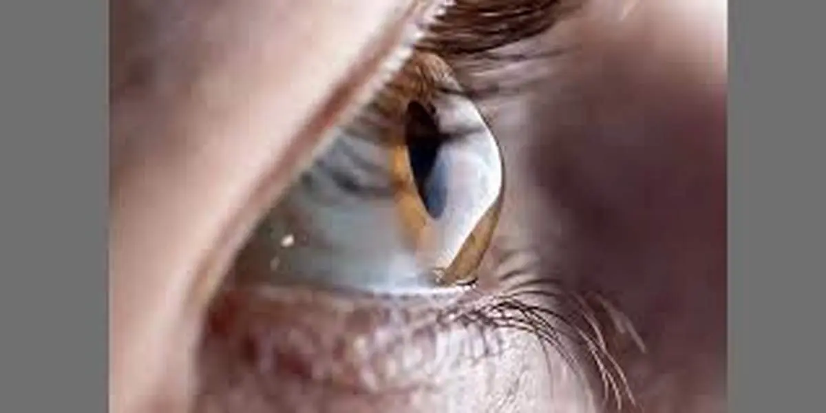 قوز قرنیه چیست؟
