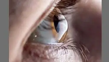 قوز قرنیه چیست؟
