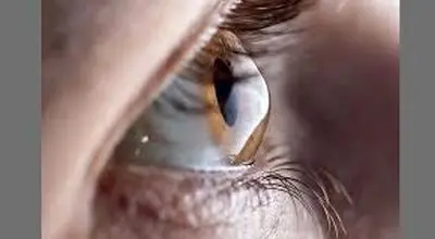 قوز قرنیه چیست؟
