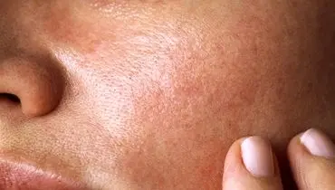 پوست شما کدام بیماری‌های پنهان را لو می‌دهد؟