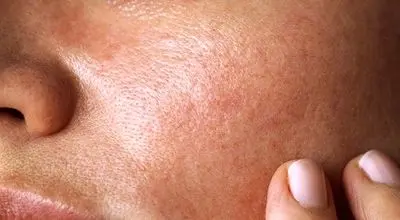 پوست شما کدام بیماری‌های پنهان را لو می‌دهد؟