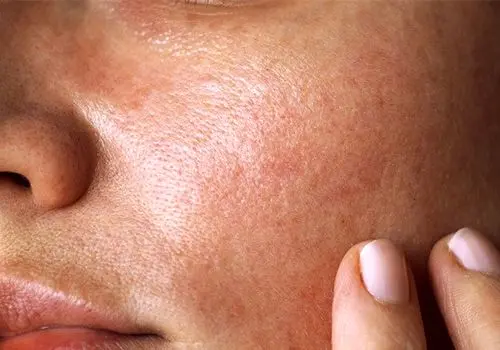 پوست شما کدام بیماری‌های پنهان را لو می‌دهد؟