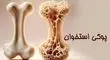 زنان بیش از مردان در معرض ابتلا به پوکی استخوان هستند
