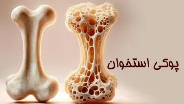 زنان بیش از مردان در معرض ابتلا به پوکی استخوان هستند
