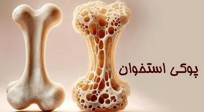 زنان بیش از مردان در معرض ابتلا به پوکی استخوان هستند
