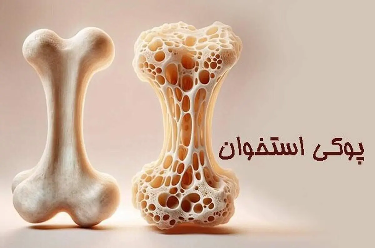 زنان بیش از مردان در معرض ابتلا به پوکی استخوان هستند
