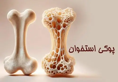 این علائم به شما میگوید دارید پوکی استخوان میگیرید
