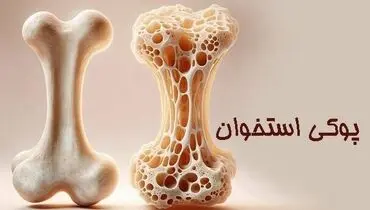 زنان بیش از مردان در معرض ابتلا به پوکی استخوان هستند
