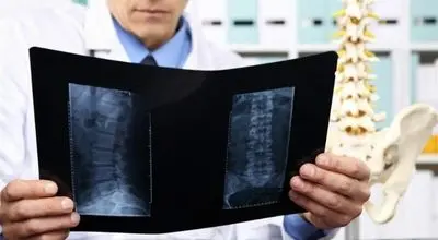 شروع روند کاهش تراکم استخوان از ۳۰ سالگی؛ هشدار برای پیشگیری به موقع