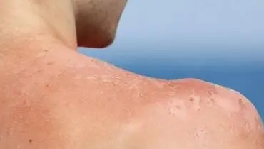چگونه از پوسته پوسته شدن پوست آفتاب سوخته خلاص شویم؟