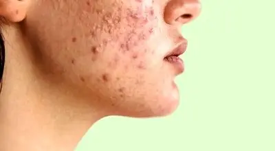 معجزه نوره برای رفع جوش‌های صورت + نحوه مصرف
