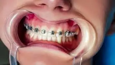 ۵ غذای سالمی که  دندان‌های شما را از بین می‌برند