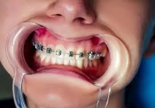 ۵ غذای سالمی که  دندان‌های شما را از بین می‌برند