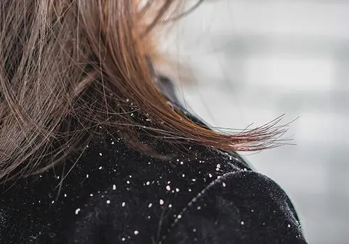آبله مرغان تا چند روز واگیر دارد ؟